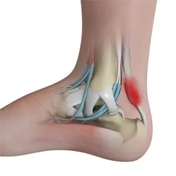 Labeled anatomy of Achilles insertional calcific tendinosis - chiropractor San Antonio TX