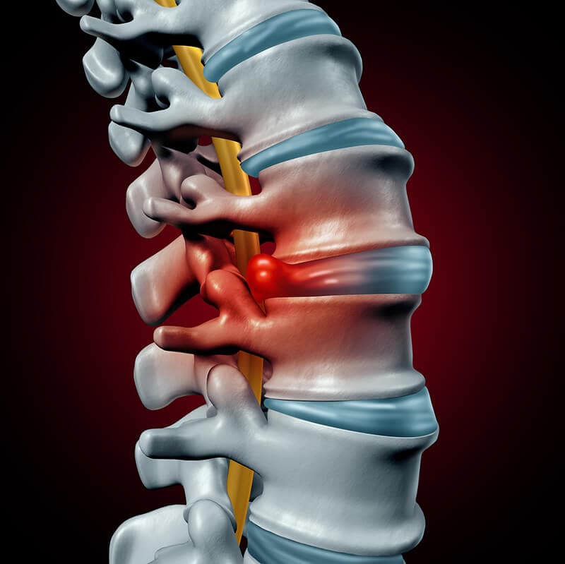 Bulging Disc Chiropractor in San Antonio, TX | Dr. Dan Foss