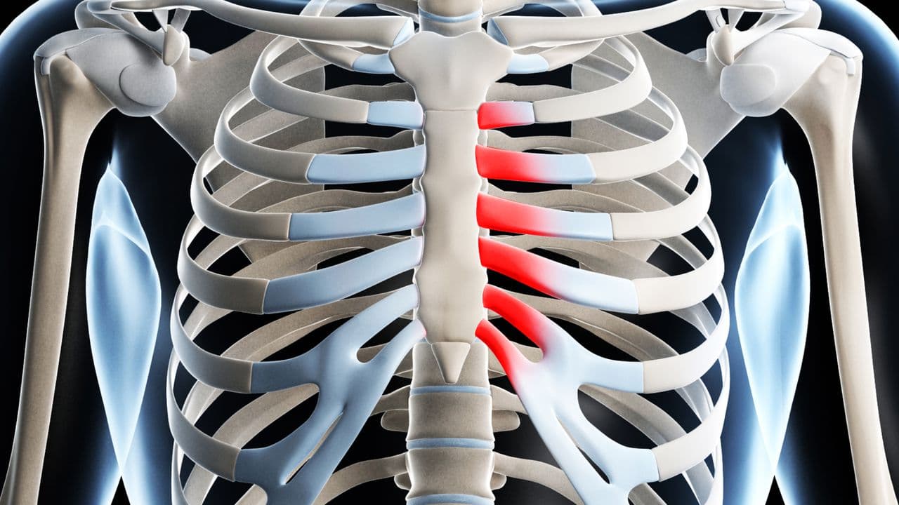 Costochondritis chest wall rib pain treatment - chiropractor San Antonio TX