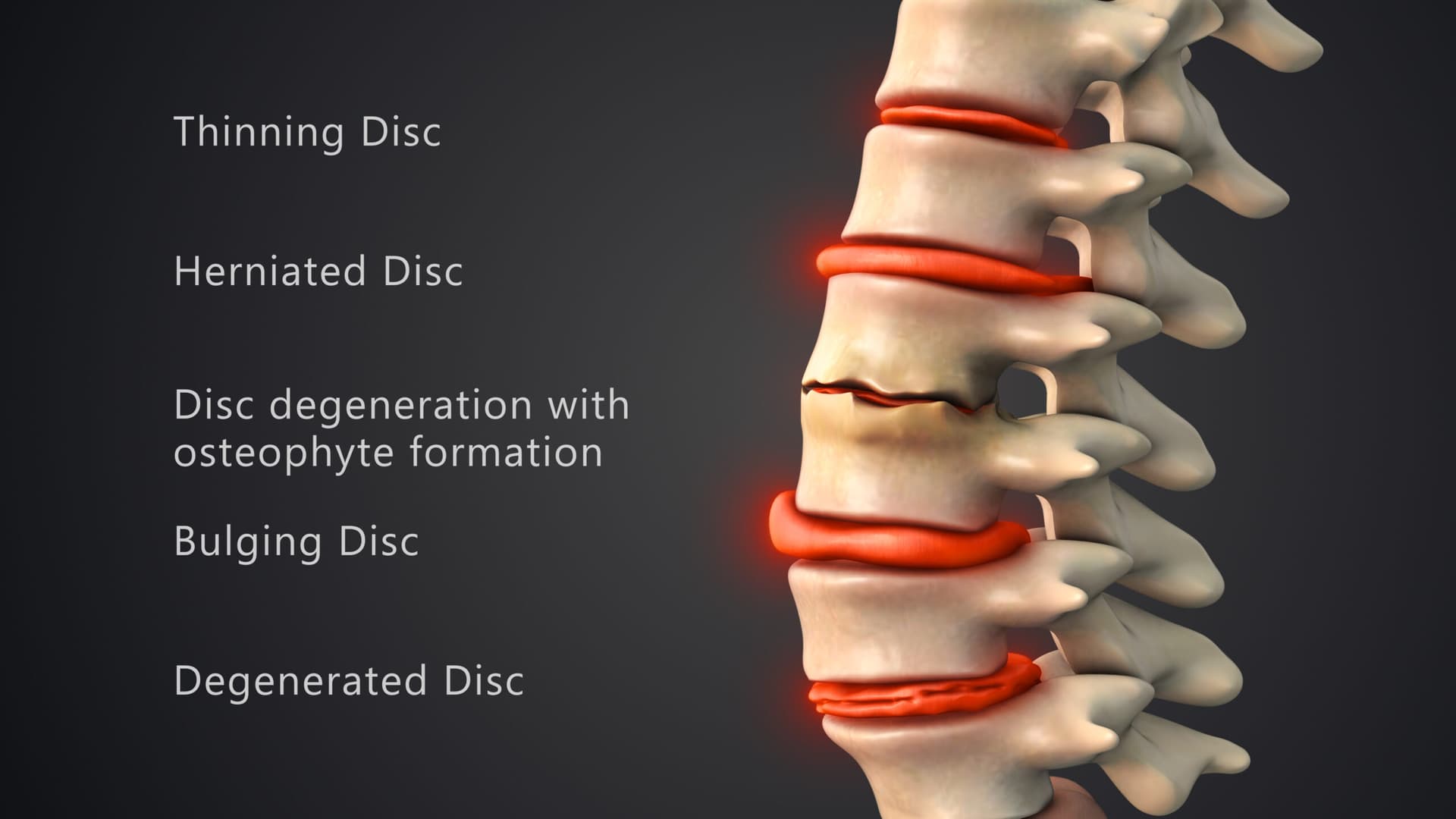 Degenerative Disc Disease Chiropractor in San Antonio, TX | Dr. Dan Foss