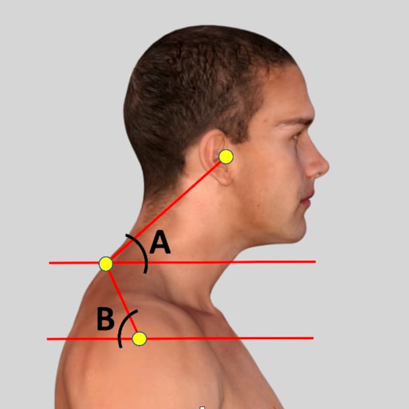 Person with forward head posture and spinal misalignment - chiropractor San Antonio TX