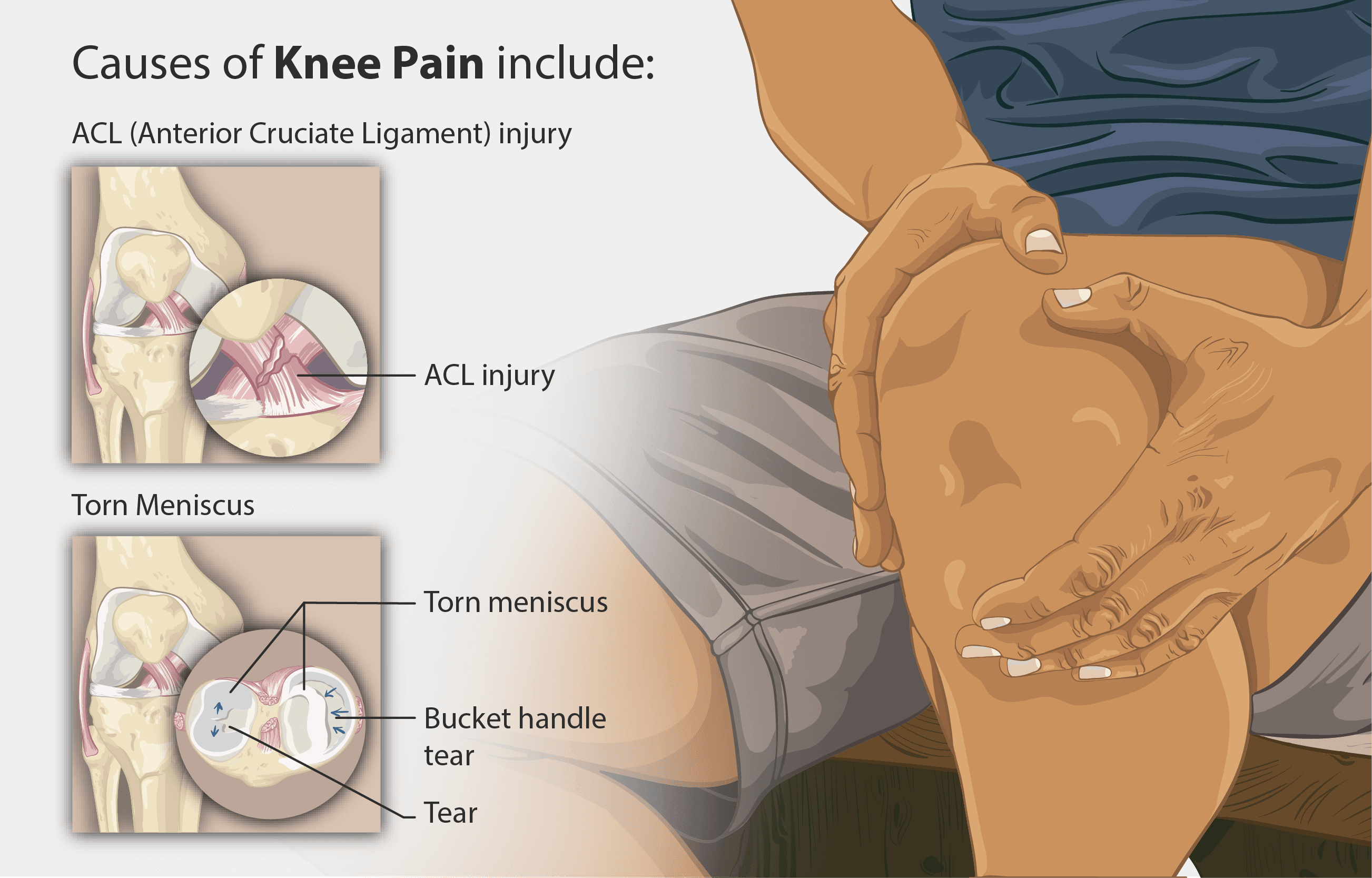 Knee pain diagram showing IT band syndrome outer knee - chiropractor San Antonio TX