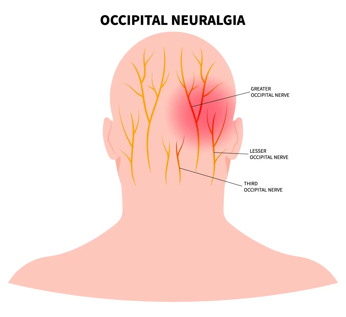 Occipital neuralgia nerve pain back of head - chiropractor San Antonio TX