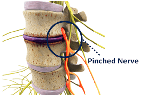 Pinched Nerve Chiropractor in San Antonio, TX | Dr. Dan Foss
