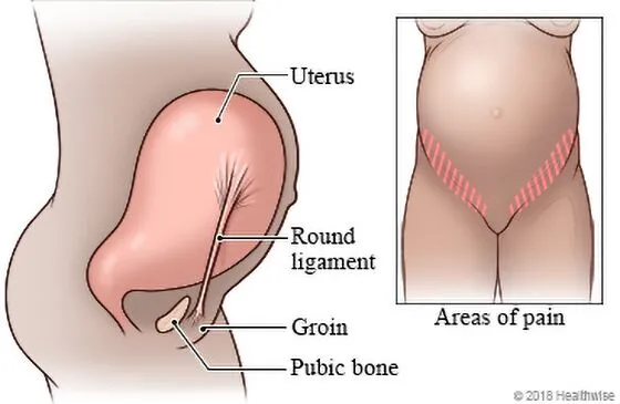 Round Ligament Pain Chiropractor in San Antonio, TX | Dr. Dan Foss
