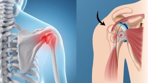 Shoulder Impingement Chiropractor in San Antonio, TX | Dr. Dan Foss