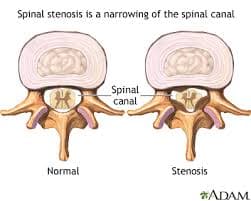 Spinal stenosis narrowing of spinal canal - chiropractor San Antonio TX
