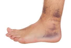 Swollen sprained ankle 30 minutes after injury - chiropractor San Antonio TX